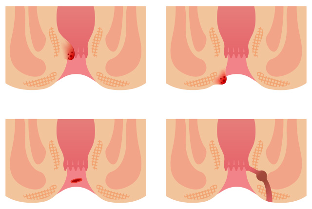 日帰り肛門手術